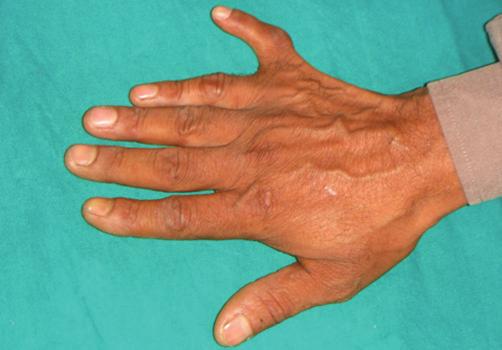 Figure 11: Polydactyly (case-ii) The etiology of the syndrome remains obscure.