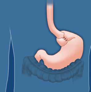 Surgery For some people, surgery to strengthen the barrier between the stomach and esophagus may be a treatment option for acid reflux.