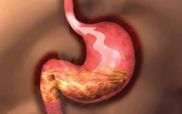 Understanding Your Condition What is gastroesophageal reflux disease?
