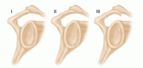 Page 5 of 35 It is also thick in forming its processes: coracoid, spine, acromion, and glenoid.