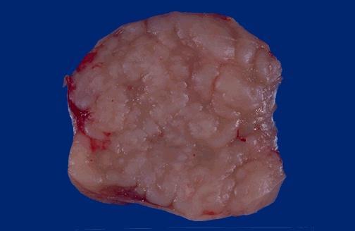 a 5 cm lymph node. The node should normally be soft and pink and less than 1 cm in size.
