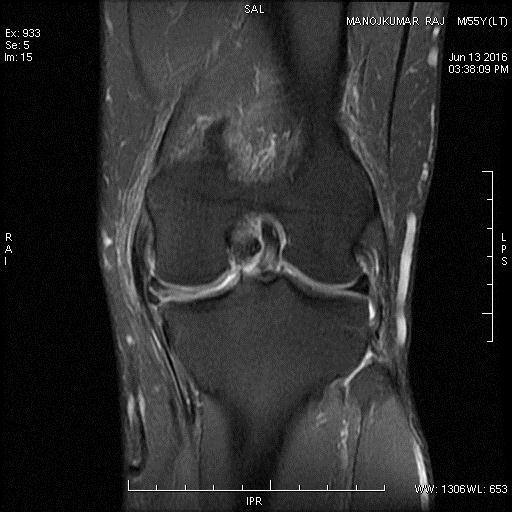 20 Fig 1: Sagittal FAT SAT MRI Knee Showing High Signal In Medial Meniscus; Grade- 1 Fig 2: High Signal Intensity Extending to One Articular Surface; Grade 2 Fig 3: Coronal FAT SAT KNEE MRI Showing