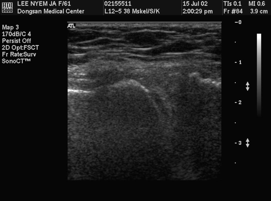 Tear in posterior