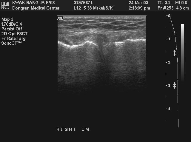 Lateral Meniscus Tear with Meniscal Cyst