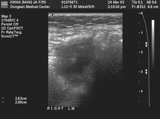 suspected meniscal cyst posterolateral to