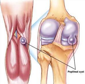 Baker s cyst (Popliteal Cyst) Origin : from the