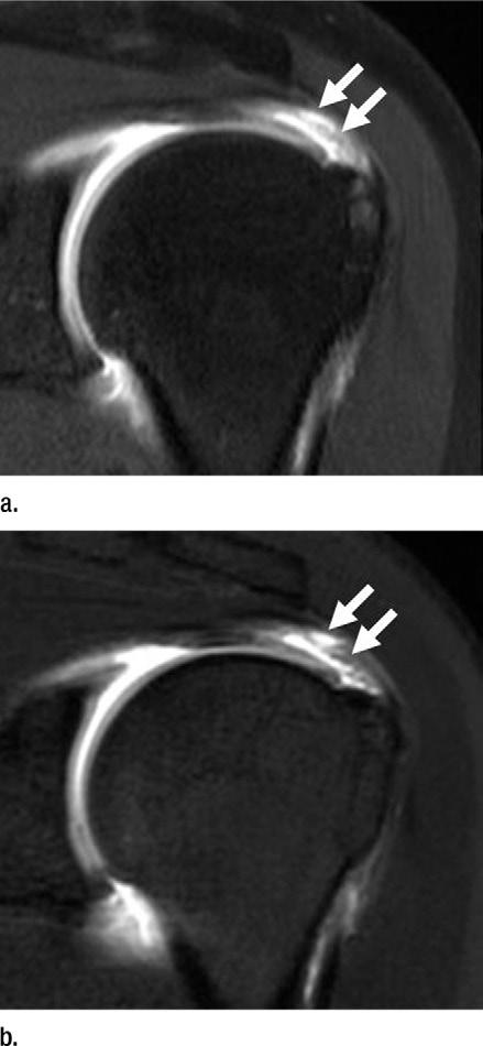 We considered a score of 3 or more to indicate a positive MR imaging result. Sensitivity and specificity for all types of rotator cuff tears and labral lesions were calculated.