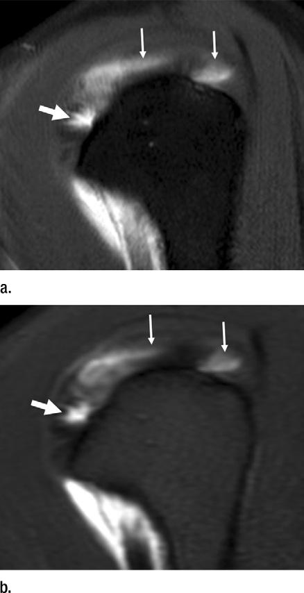 revealed a large amount of synovitis coexistent with a full-thickness tear. SCT tears. Arthroscopic surgery revealed four full-thickness tears of the SCT and 17 partial-thickness tears (Fig 3).