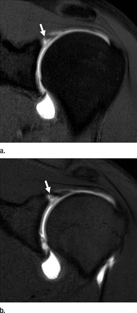 Figure 5 Table 7 Interobserver Agreement for Evaluation of Rotator Cuff Tears and Labral Lesions Abnormality 2D FSE 3D T1-weighted FSE SST-IST tear All* 0.95 (0.888, 1.000) 0.90 (0.790, 1.000) 0.96 (0.