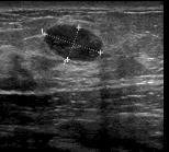 Discuss with your doctor Ultrasound Recommend the use ultrasound in those with dense breast