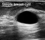 waves to make images of the breast Ultrasound US complements other tests Mammogram or
