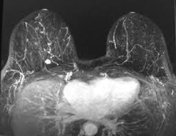 Breast MRI The sensitivity of breast