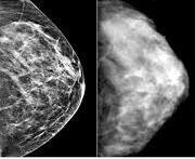 reduction in breast cancer mortality in