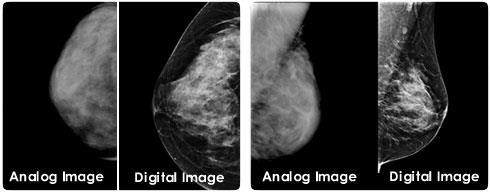 introduced in early 1990 s 3D mammography
