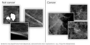 calcifications are more likely