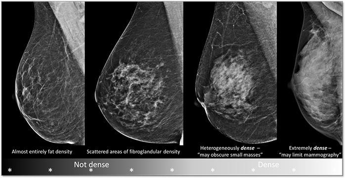 Density of breast tissue A B C D 0-25% 25-50% 50-75% > 75% Self Breast Exams Examining your breasts every month is a way to find a breast cancer early