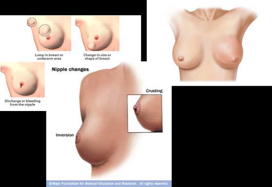 Breast Signs and Symptoms