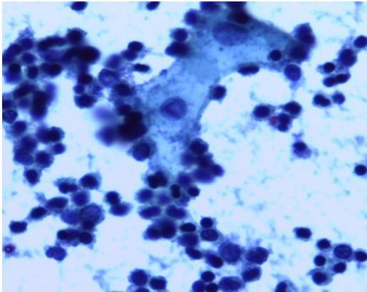 PLATE 2: Urine cytology of furniture workers above ten years exposure