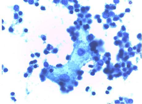 cytology of furniture workers above twenty years exposure showing