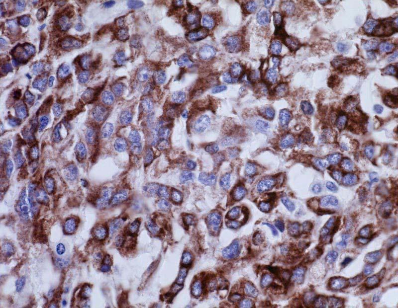 CK19 Ulex europaeus Mucinous Tubular and Spindle Cell Carcinoma THP CD 10 und