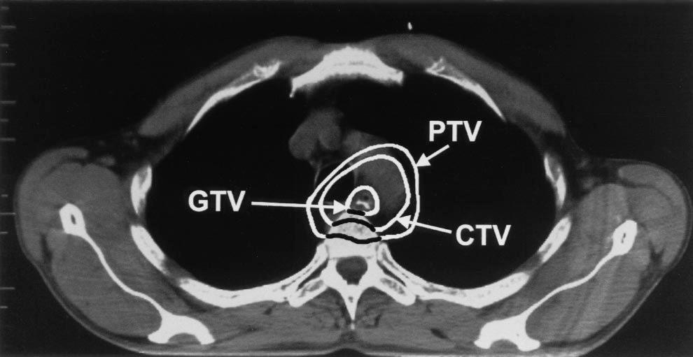 CT Localisation of Target Volume Gross Tumour Volume (GTV)