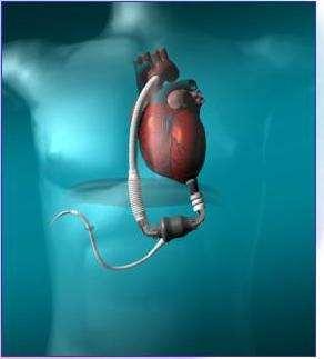 HEARTMATE II LVAD FDA Approved for BTT or DT Axial flow- they may not have a pulse and you may need a