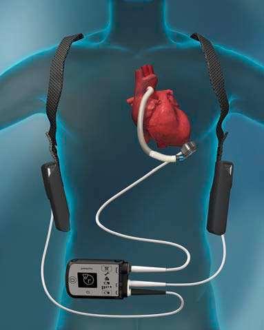 HeartMate III LVAS In Clinical Trials 60 selected centers FDA Approved BTT/recovery 8/2017 Centrifugal flow- Magnetically Levitated
