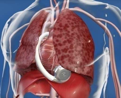 HeartWare HVAD FDA Approved for BTT not approved for DT yet Centrifugal flow- they may not have