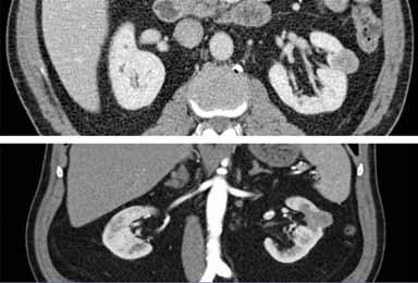 small renal masses is limited, being based on small, retrospective series.
