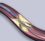 THE PROCEDURE Angioplasty STEP 1 The balloon catheter is passed through the guiding catheter to the area near