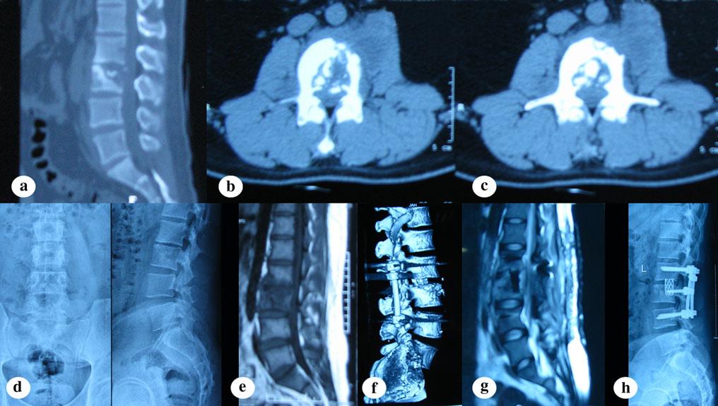 Arch Orthop Trauma Surg (2013) 133:333 341 337 Fig. 1 A 46-year-old female was diagnosed as having tuberculous spondylitis after a 13 months history of severe back pain.