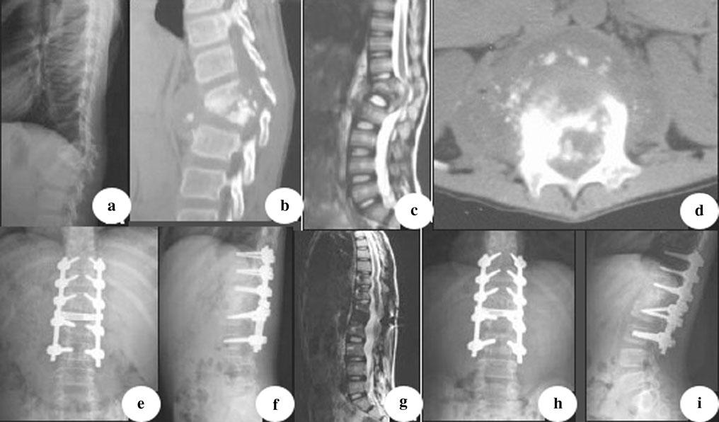 338 Arch Orthop Trauma Surg (2013) 133:333 341 Fig. 2 An 11-year-old boy was diagnosed as having tuberculous spondylitis after a 7 months history of severe back pain.