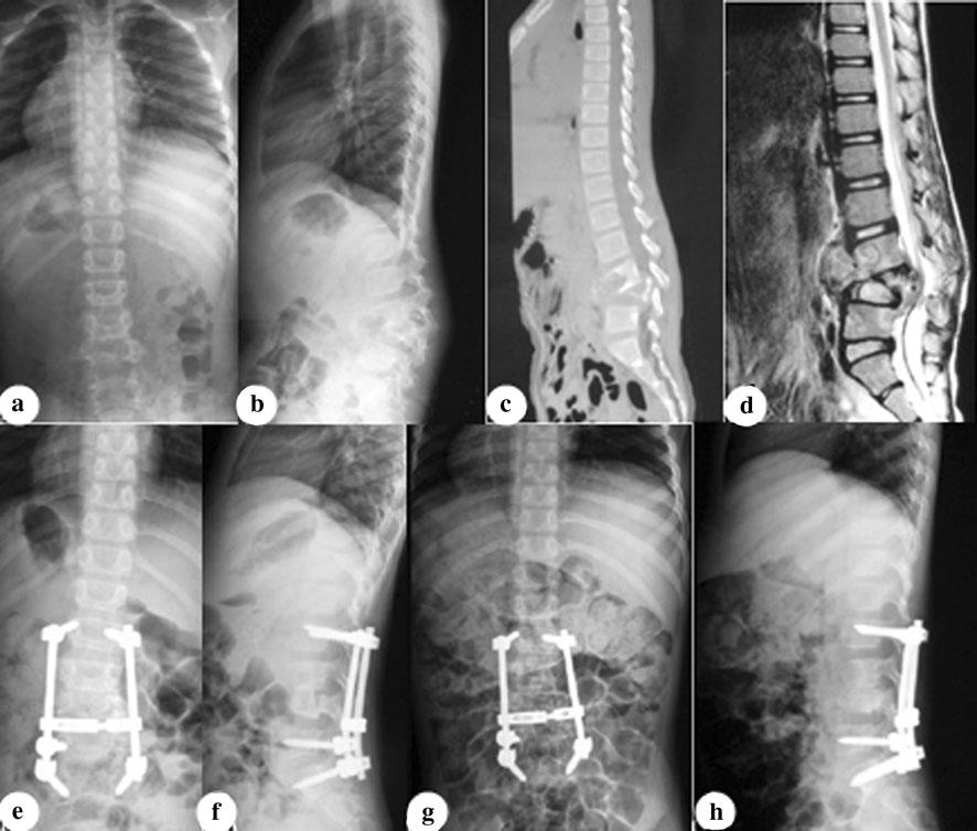 Arch Orthop Trauma Surg (2013) 133:333 341 339 Fig. 3 An 11-year-old girl was diagnosed as having tuberculous spondylitis after a 5 months history of severe back pain.
