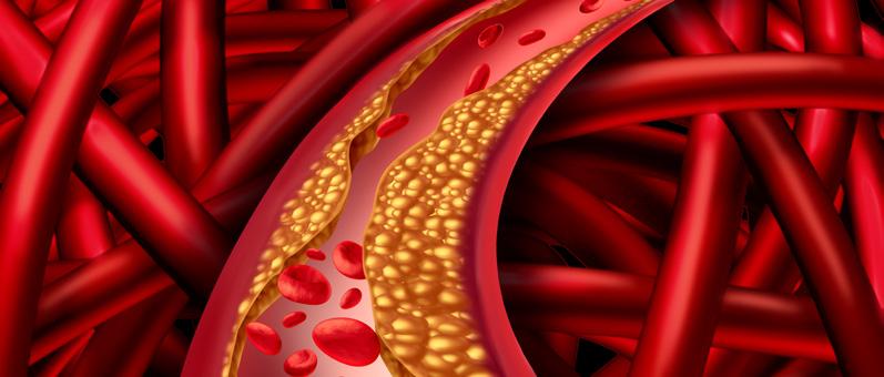 Why cholesterol is important for your health Elevated LDL-cholesterol is widely known to be one of the risk factors in developing coronary heart disease*, causing atherosclerotic plaque which builds
