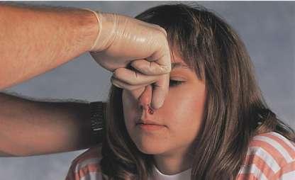 Cerebrospinal fluid coming from the nose is indicative of a
