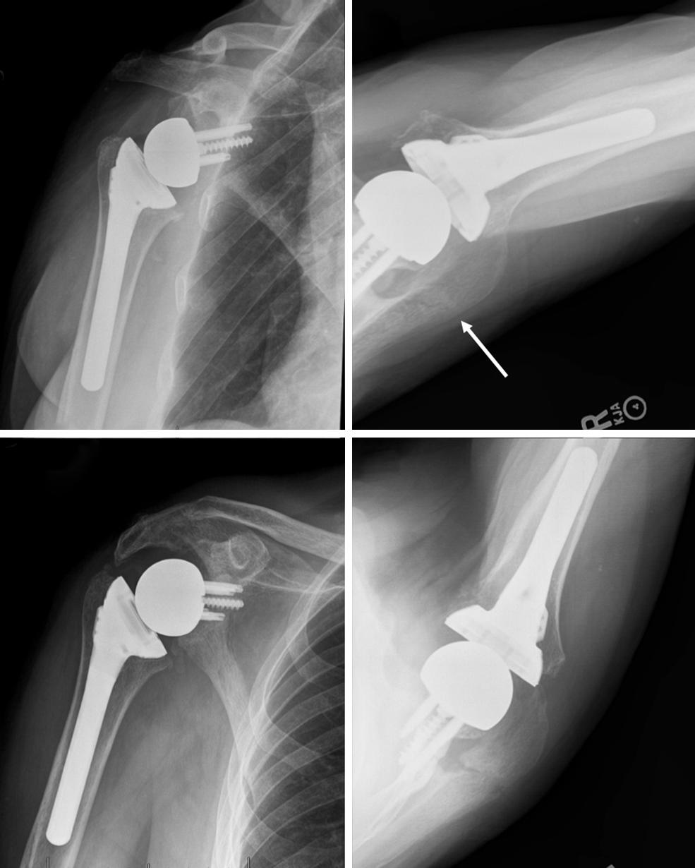 Annals of Joint, 2019 Page 3 of 8 A B A B C D C D Figure 1 Radiographs of an 80-year-old male who sustained Figure 2 A 52-year-old female with rheumatoid arthritis presented an acromial base fracture