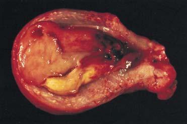 http://en.wikipedia.org/wiki/file:endometrial_stromal_sarcoma_gross.