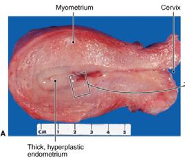 Obesity Chronic Anovulation PCOS Tamoxifen use Risk of progression to Cancer Simple hyperplasia without atypia 1% Complex hyperplasia without atypia 3% Simple
