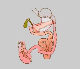 Unit 1: 3: Obesity Surgical Management Procedure Biliopancreatic diversion (BPD) In this procedure, portions of the stomach are removed.