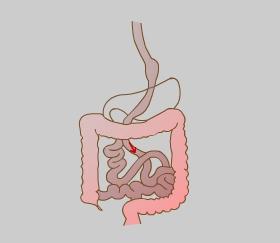 intestine). Although this procedure successfully promotes weight loss it may lead to nutritional deficiencies. Biliopancreatic diversion (Fig.15) (Refer fig.