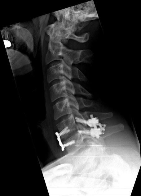 indicated injury to the spinal cord that was significant enough to recommend stopping the sport (Figure 4). The patient s symptoms resolved with conservative management.