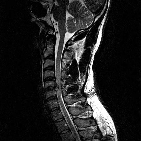 Two-month postinjury magnetic resonance imaging showing persistent herniation and spinal cord compression.