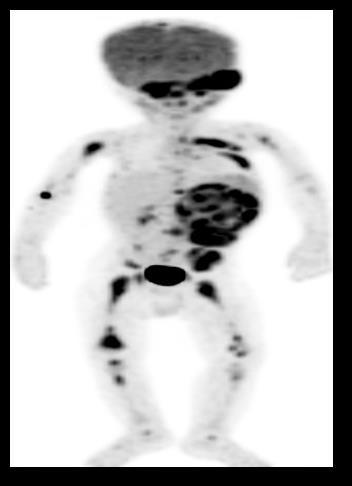 Figure (1) revealed MIBG avid suprarenal mass with multiple osseous infiltrates, while PET MIP revealed the FDG avid left suprarenal mass with multiple osseous lesions with better delineation of the