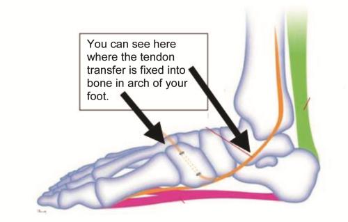 What is involved in an Os Calcis Osteotomy and tendon transfer?