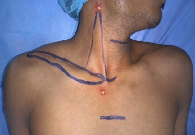 Introduction Cannulation of a large central vein is the standard clinical practice, done usually through the internal jugular vein (IJV), the subclavian vein, and the femoral vein for the