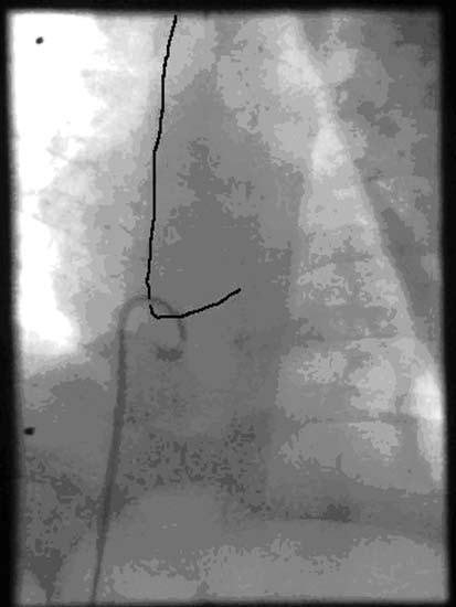 A 4F pigtail catheter was passed via the left femoral vein into the right superior vena cava right atrial junction to hook on to the atrial portion of the PICC (Fig. 2).