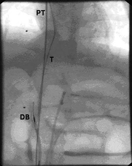 Transcatheter Removal of PICC Fig. 3.