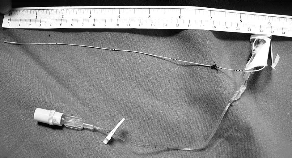 Original Article Fig. 5. The complete length of the peripherally inserted central catheter was withdrawn from the axillary end after it was freed from its adherent position in the ventricular septum.
