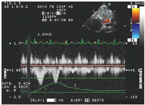 Respiratory variation in right ventricular size and septal position in patient with pericardial tamponade.