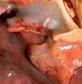 ventricular systole.